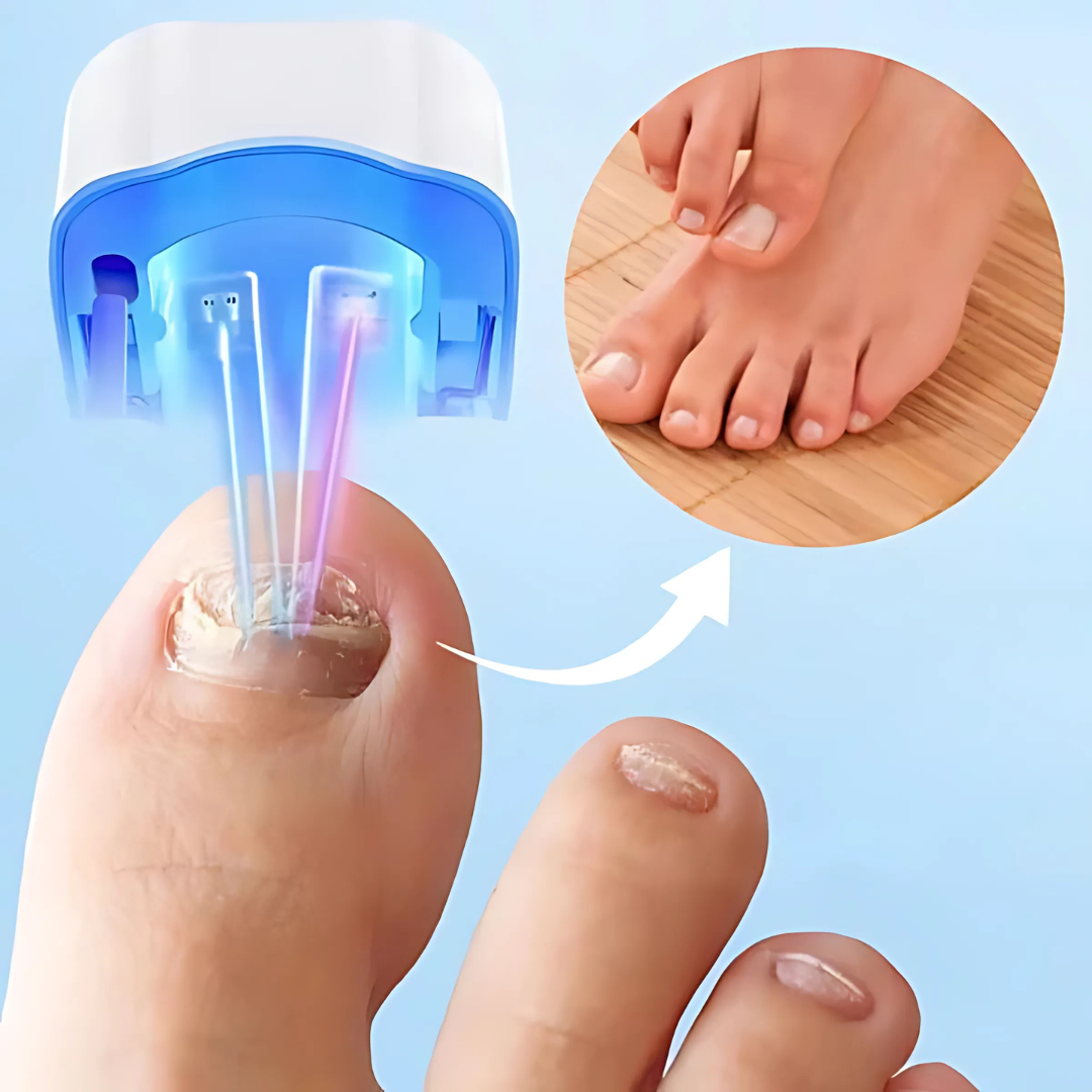 Advanced Nail Fungus Treatment | Infrared Laser Device for Toe Nail Fungus 3