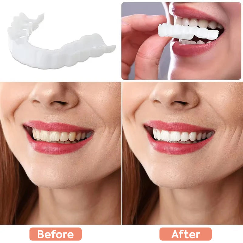Comfortable Clip-On Veneers | Natural White Composite Finish 5