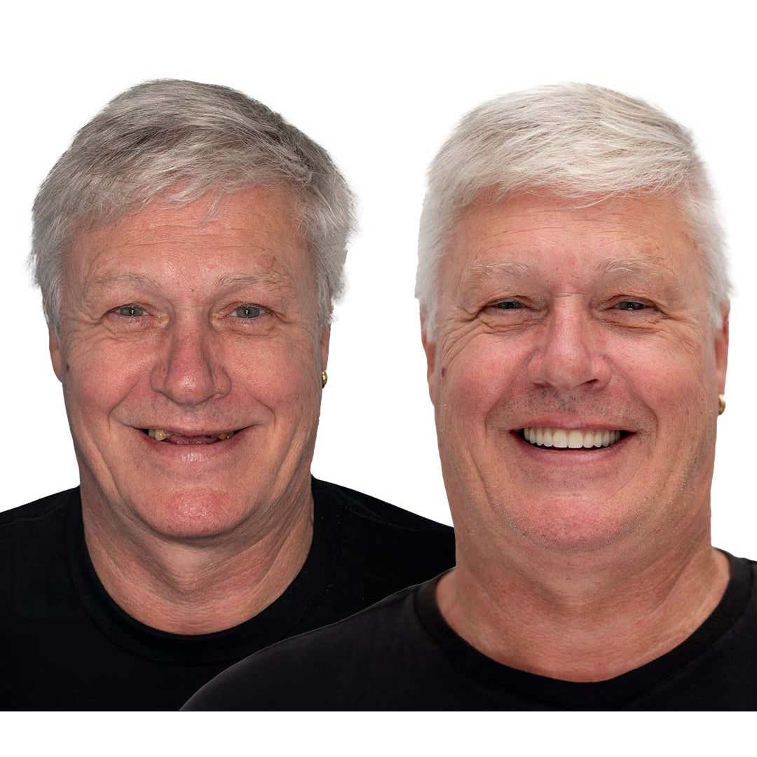 Natural-Looking Dentures Comfort and Confidence Smiling - Image 10