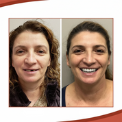 Removable Dental Prosthesis Natural Smile Comfortable Fit - Image 1