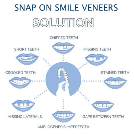 Smile Veneer Teeth Cover Set Instant Smile Makeover Home - Image 6